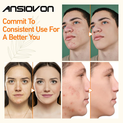 Microcurrent facial machine — ANSIOVON blue light therapy for acne treatment