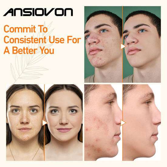 Microcurrent facial machine — ANSIOVON blue light therapy for acne treatment